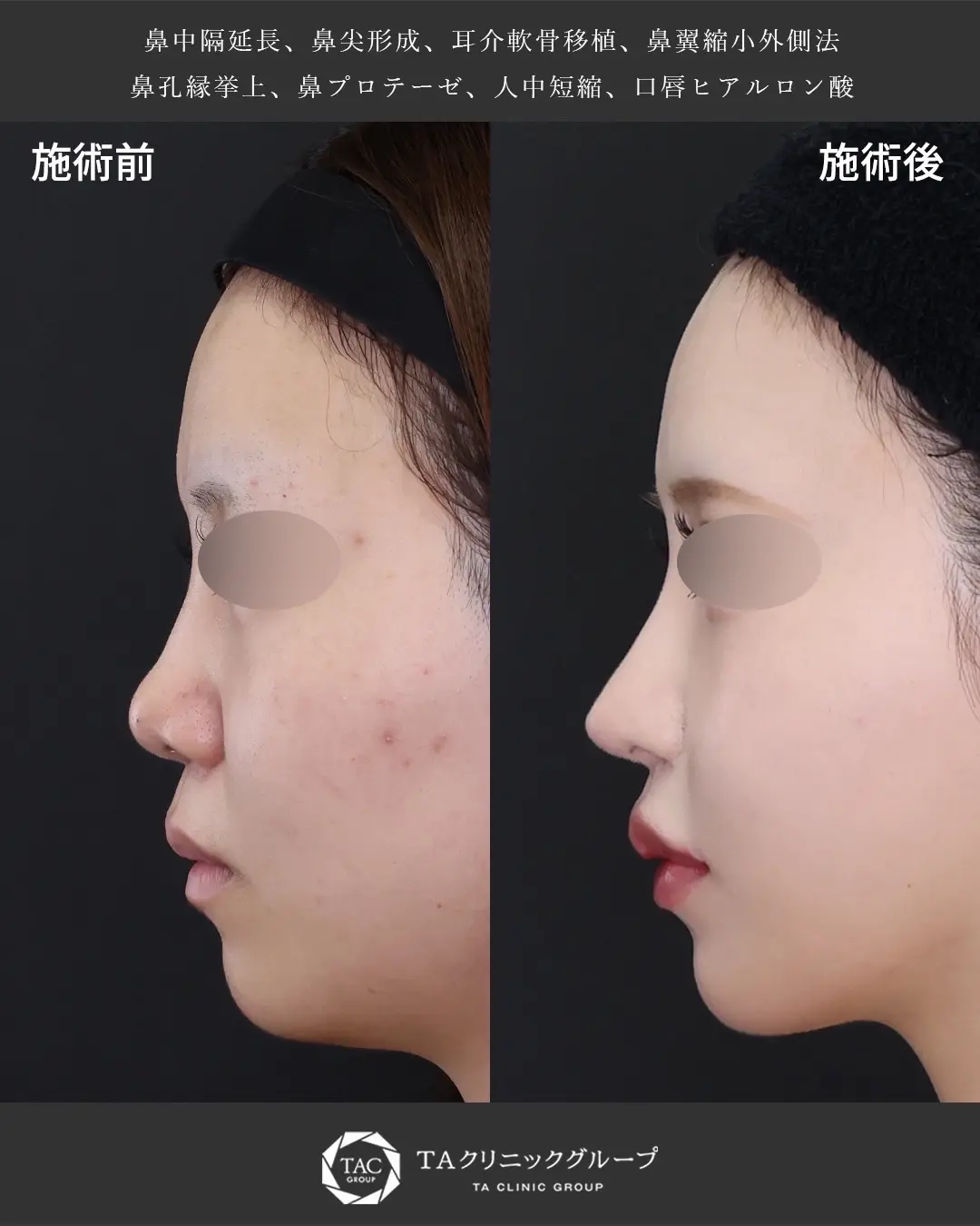 鼻整形施術 症例