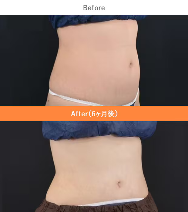 医療ダイエット