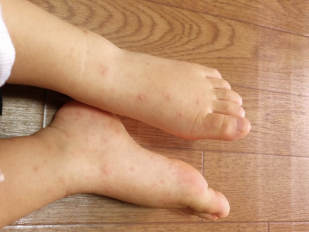 手足口病の症状を解説 手足口病の感染経路や潜伏期間は 手足口病の特徴と注意点や予防法もご紹介します イシャチョク
