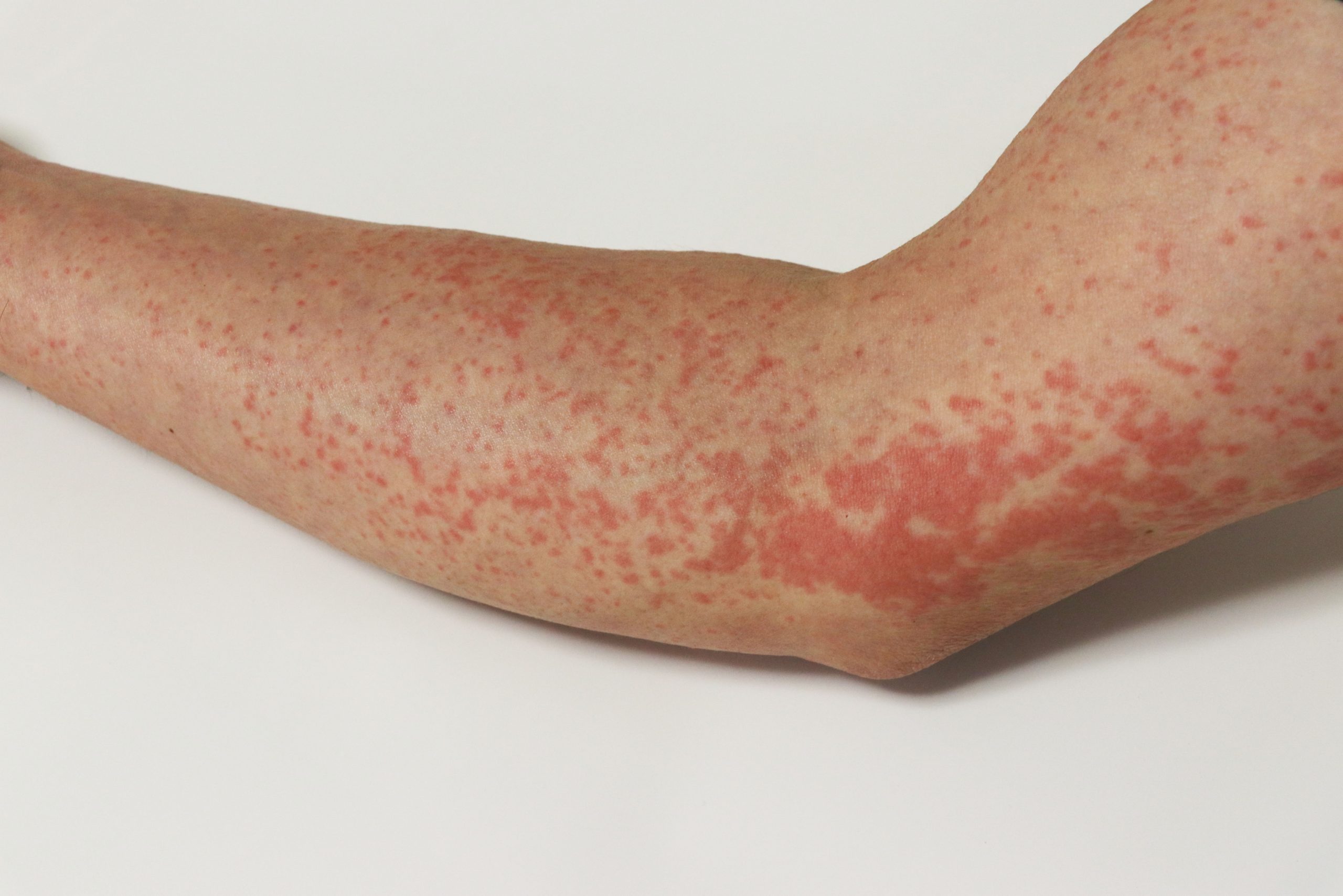 逆乾癬と間擦疹の原因は何ですか?