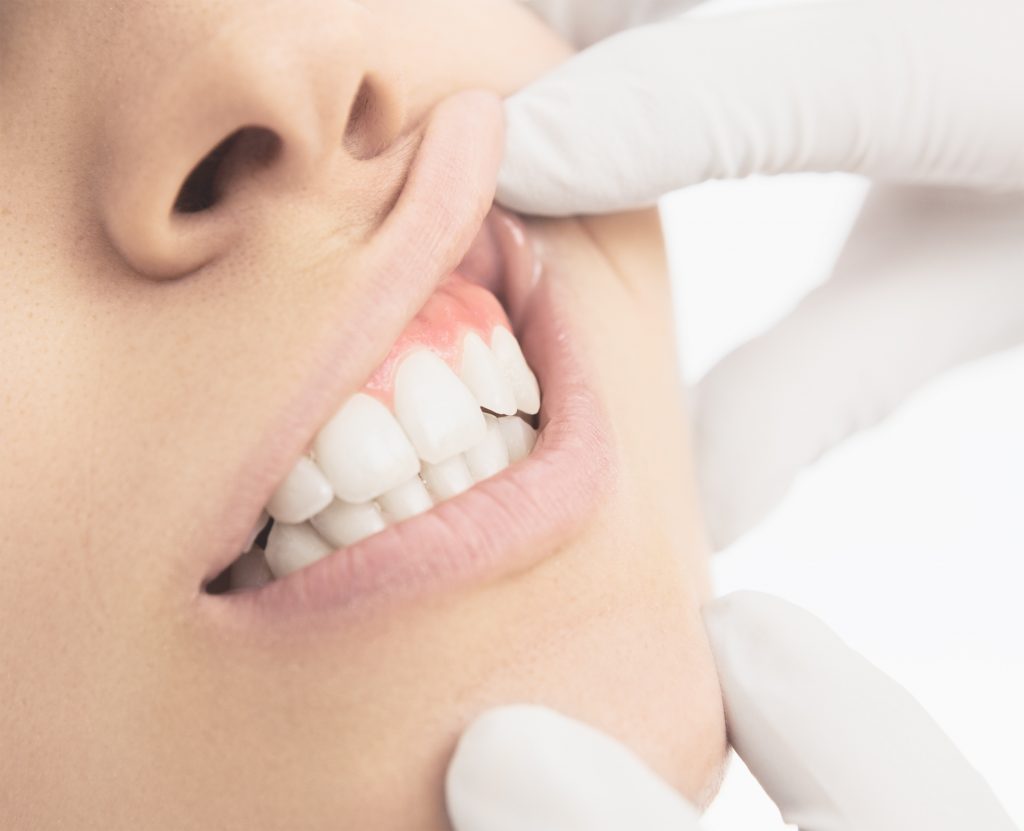 歯茎に白いできものができる原因とは 口のなかにニキビ イシャチョク