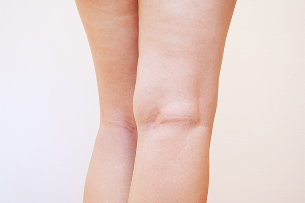 歩きすぎて膝の裏が痛いときの対処法 予防法とは イシャチョク