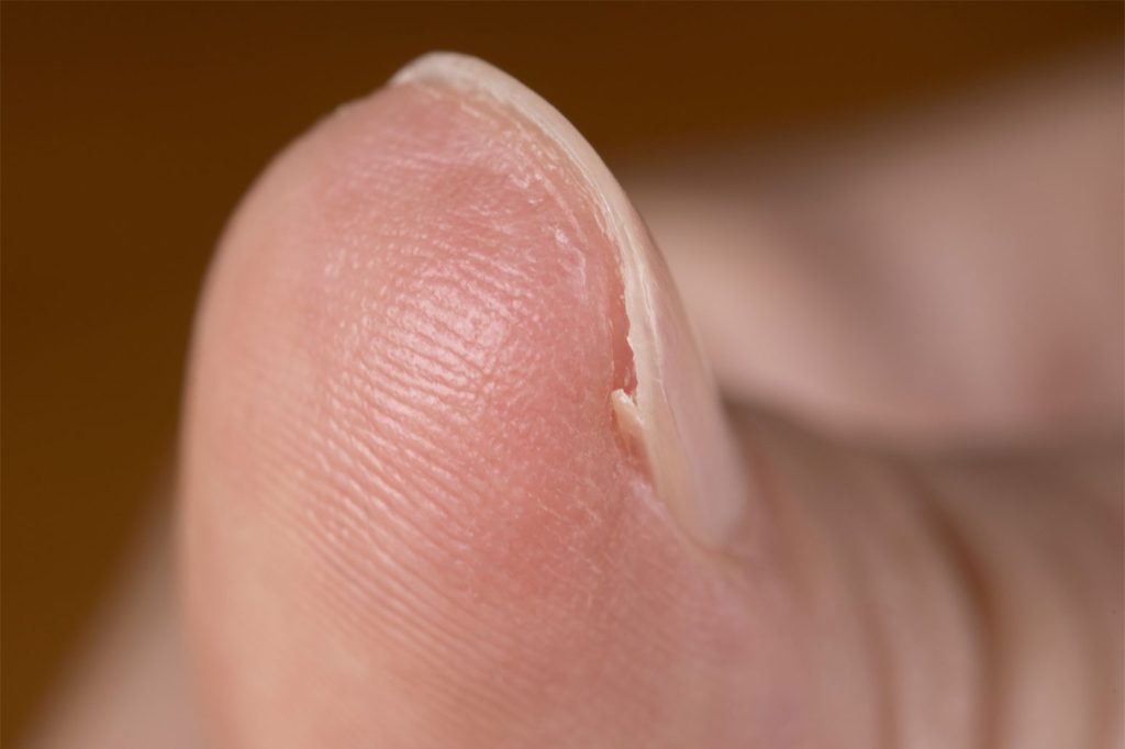 巻き爪で指が痛いときの対処法は 応急処置や病院の処置 陥入爪についても解説 イシャチョク