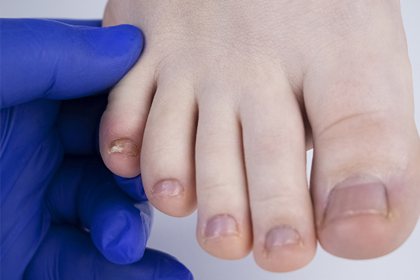 足の小指 小趾 が痛い原因とは 痛みと関連のある病気も徹底紹介 イシャチョク
