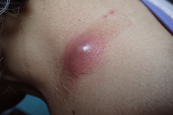 体にできた「盛り上がったやわらかいしこり」の適切な治療方法