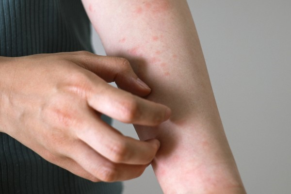 【医師が警告】「湿疹」に「市販の塗り薬」を安易に使ってはいけない理由