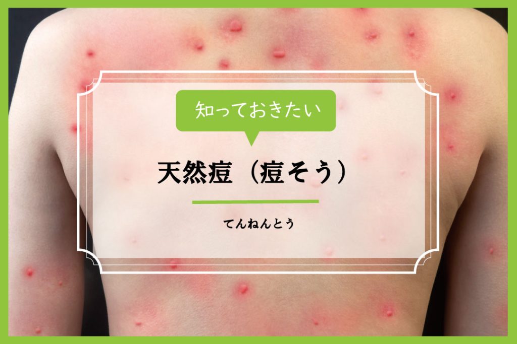 天然痘(痘そう)【イシャチョク】