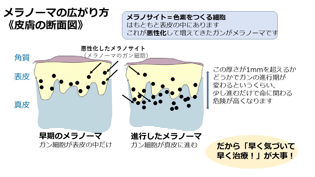 「ほくろ」みたいにみえる皮膚がん…注意すべき点と見分け方【イシャチョク】