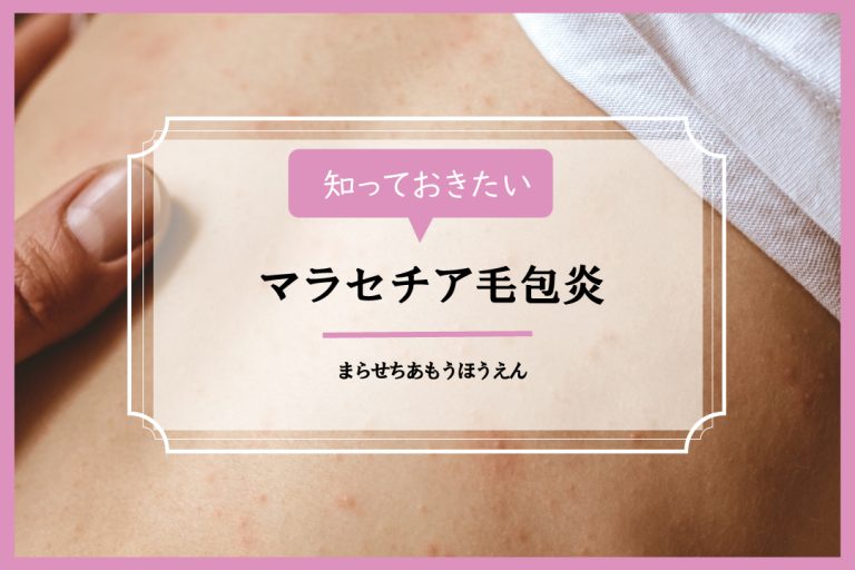 マラセチア毛包炎【イシャチョク】