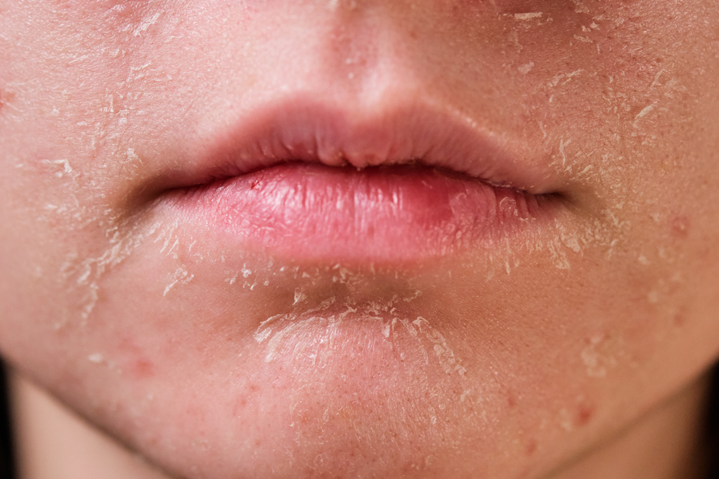 顔の皮膚がポロポロむけるのはなぜ 乾燥 日焼け マスクほか原因と対策を解説 イシャチョク